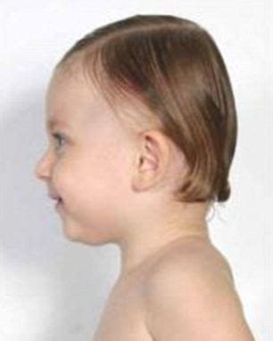 Losing hair along the temples or front hairline is distressful. Plagiocefalia: casi in aumento | Osteopatia Andrea Nitri