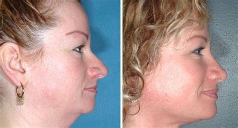 Losing face fat is not an easy process. Pin on Health