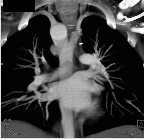 Right Aortic Arch With Aberrant Left Subclavian Artery Chest Case