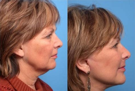 Facelift Before And After Pictures Case 93 Scottsdale And Phoenix Az