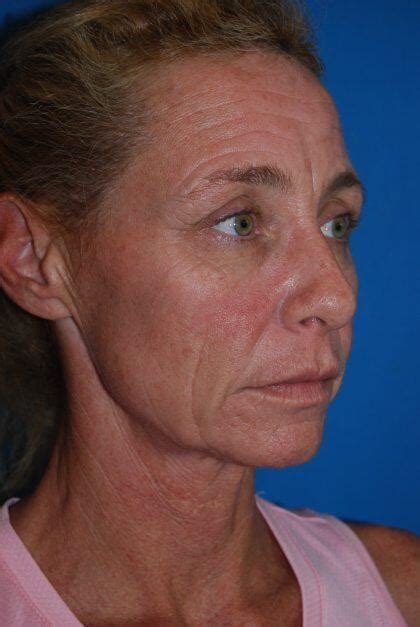 Before And After Neck Lift Procedures In Boca Raton Fl Optimization Centre