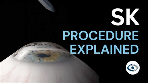 Superficial Keratectomy Sk Procedure Explained Precision Cornea