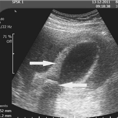 Ultrasound Findings In Acute Cholecystitis That Could Affect The