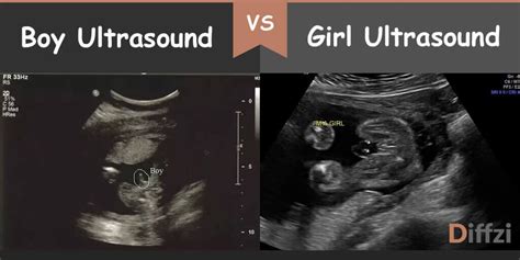 Ultrasounds Boy Or Girl Hiccups Pregnancy