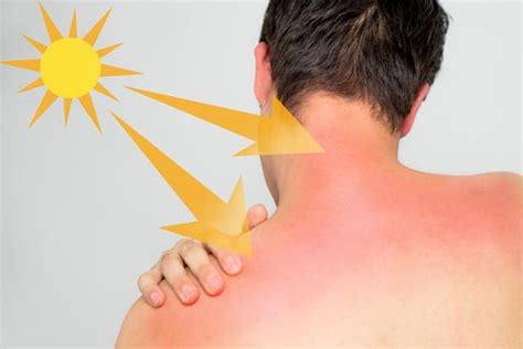 Does Sunburn Cause Skin Cancer Kendall Dermatology