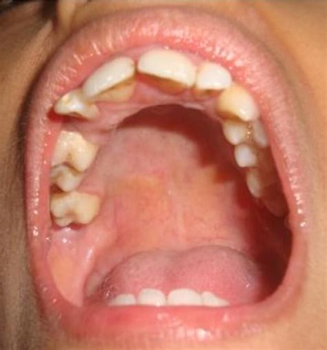 What Is High Arched Palate Or Gothic Palate News Dentagama