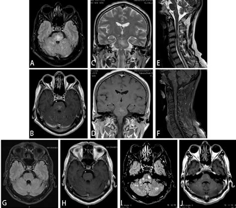 Whether clippers represents an independent, actual new disorder or a syndrome that includes aetiologically heterogeneous diseases and/or their prestages remains a debated and not finally. CLIPPERS syndrome responsive to Leflunomide: A case report ...