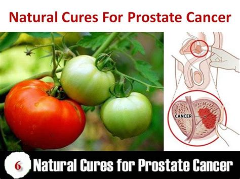 Masiero s., pigliaru f., boscaro m., scaroni c., betterle c. Prostate Cancer & Prostatitis Treatment with Natural Home ...