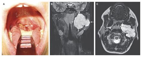 Tonsillar Asymmetry From A Parotid Tumor Nejm