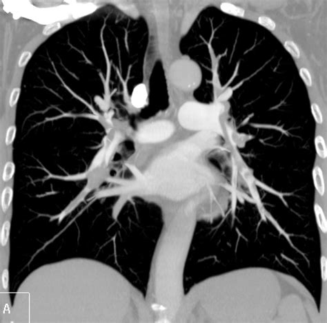 My E Radiology Cases Case 432 65 Year Old Man With Acute Dyspnea