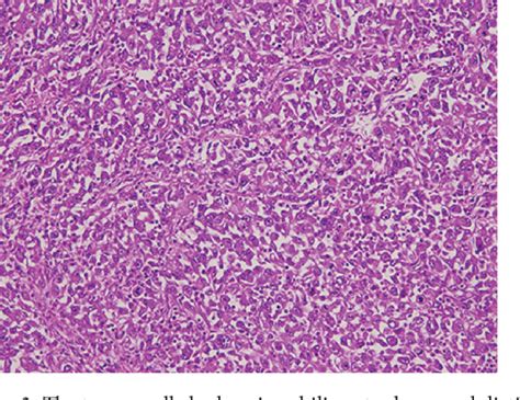 Figure 3 From A Case Of An Undifferentiated Squamous Cell Carcinoma