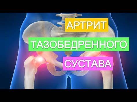 Артрит тазобедренного сустава диета