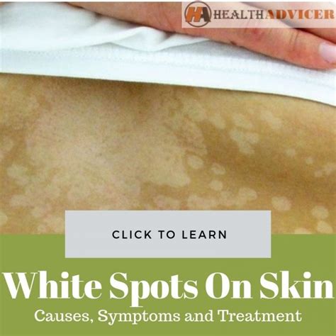 White Spots On Skin Causes Picture Symptoms And Treatment