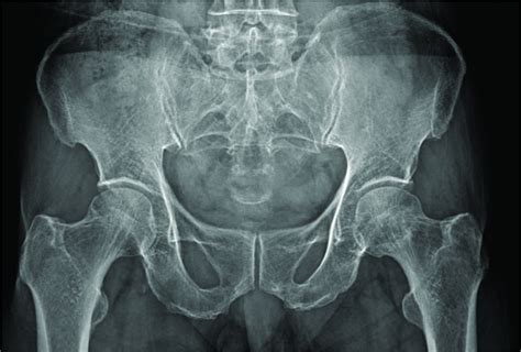 X Rays And Scans Can Fail To Differentiate Hip Pathology From Lumbar