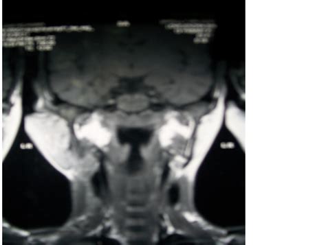 Kimuras Disease—a Rare Cause Of Head And Neck Swelling