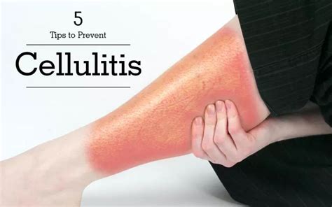 Cellulitis Treat Your Skin Infection Before Its Too Late Hakeem
