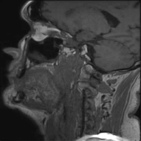 Palatine Tonsil Squamous Cell Carcinoma Image