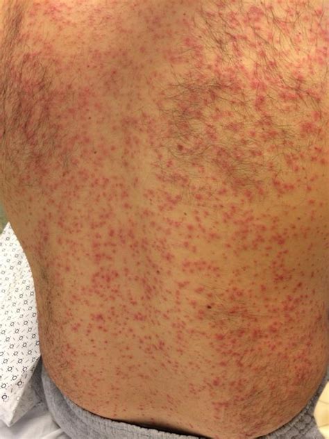 Erythematous Papular Rash