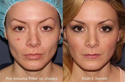 Juvederm Vs Botox Whats The Difference Cosmetic Laser Dermatology