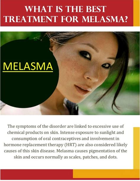 The Best Treatment For Melasma