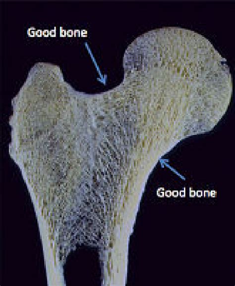 Over time bird bones have evolved specializations that maximize stiffness and strength, dumont says. Cross section of the proximal femur | Download Scientific ...