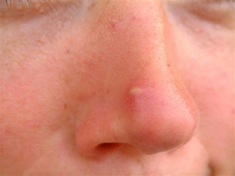Top 10 How To Treat A Pimple On Your Nose In 2022