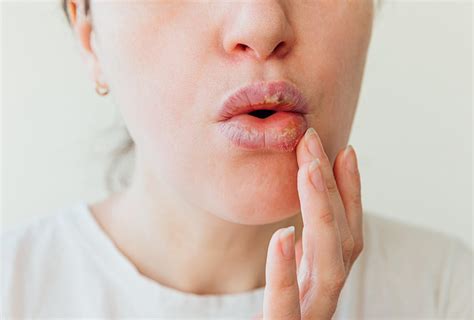 7 Home Remedies For Swollen Lips Emedihealth