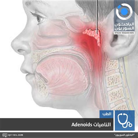 Anatomy Of Adenoids And Pallate