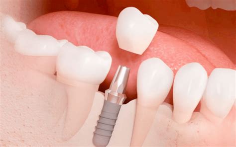 Implantes Dentales Todo Lo Que Debes Saber Cl Nica Dental Abril