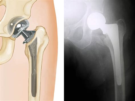 Hip Fractures Orthoinfo Aaos
