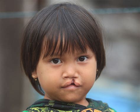 Questions And Answers About Clefts Smile Train