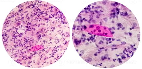 Paps Smear Microscopic Examination Of Pap Smear Showing Inflammatory