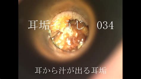 耳垢そうじ/耳から汁が出ると感じた軟耳垢/034 - YouTube