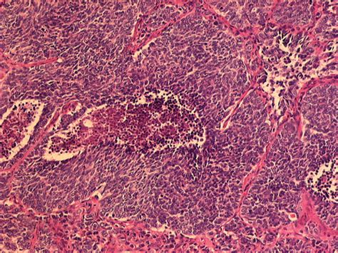 Large Cell Neuroendocrine Carcinoma With Formation Of Typical Spherical
