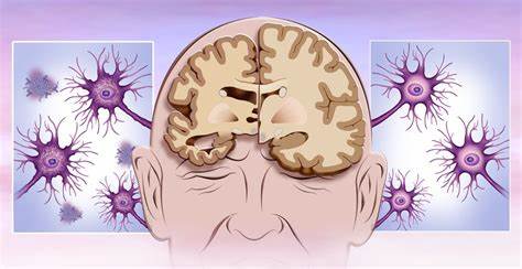 Alzheimer's can change mind designs in youth