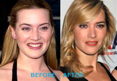 Photos Free Photo Gallery Blog Plastic Surgery Dimple Photos And Images