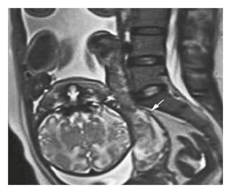 The Mri Image Of A Partial Placenta Previa Case A The Sagittal