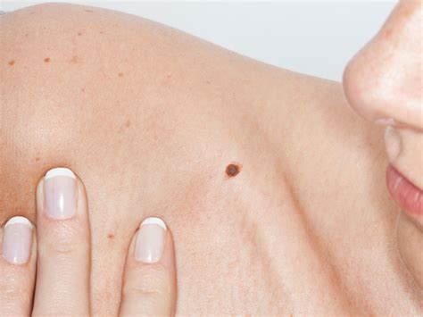 Srt Treatment For Skin Cancer Gains Popularity But Its Not For