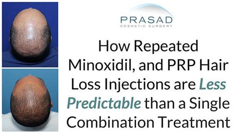 Why Multiple Minoxidil Injections For Hair Loss Treatment May Be Needed