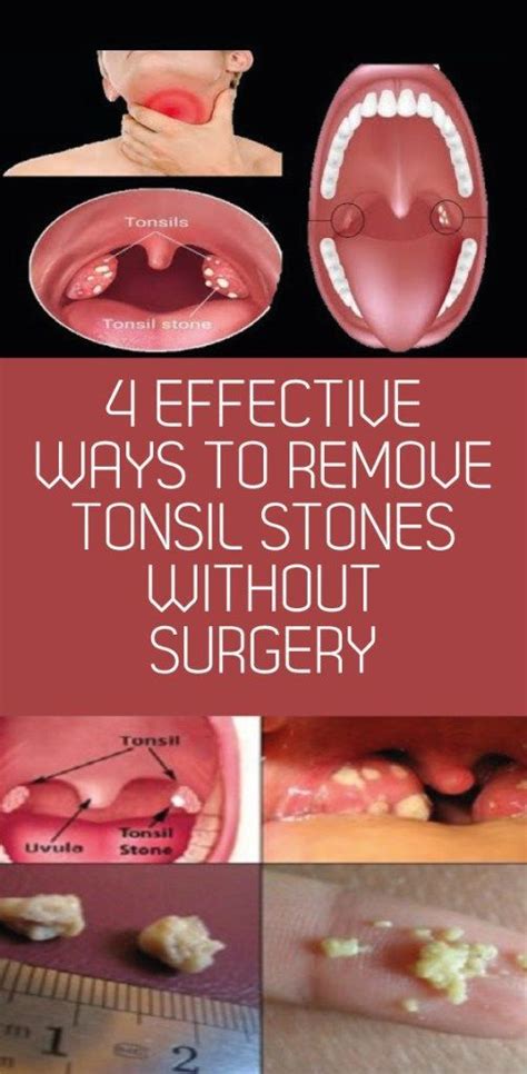 Pin On Tonsil Stones