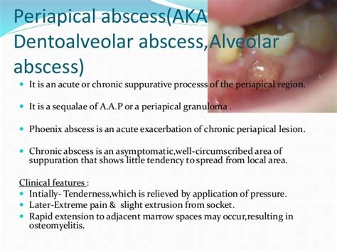 Apical Periodontitis Vs Apical Abscess