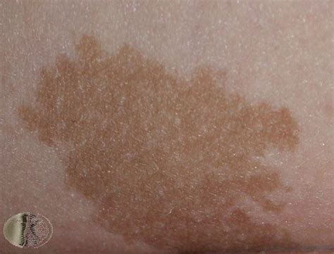 Everything You Need To Know About Benign Skin Lesions Geelong Veins