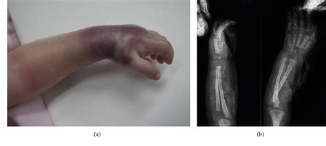 Figure 1 From Forearm Compartment Syndrome Of A Newborn Associated With