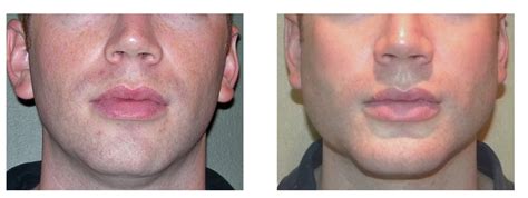 Chin And Jaw Angle Implants Image Courtesy Of Dr Bary Eppley Dr Cate