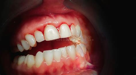 Severe Gingivitis Stock Image Image Of Mouth Abscess 27276699