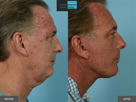 Facelift Before And After Photos That Prove Just How Natural Todays Results Look TLKM