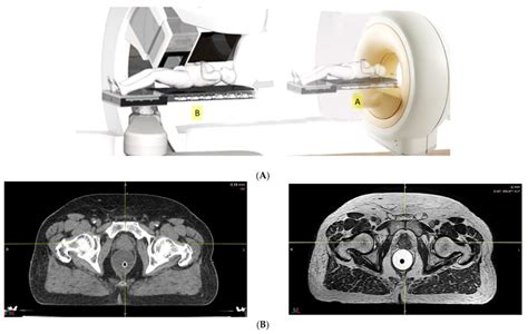 The Benefits Of Proton Therapy For Prostate Cancer Why It Matters And How It Works A Rich Health