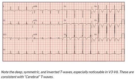 Cerebral T Waves Are Deep Symmetric Inverted T Waves Grepmed