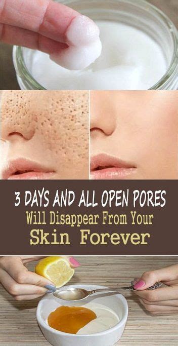 How To Get Rid Of Enlarged Pores Naturally Skin Treatments Skin