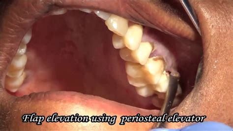 Extraction Of Decayed Upper Molar Tooth Youtube